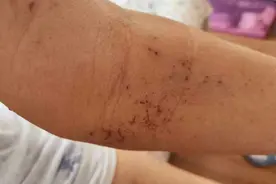 这个靶向药常见副作用，真的很难忍！毒性管理应对有方，患者医生都要学图片