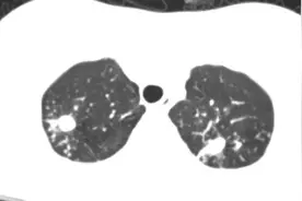 结核“长”在了皮肤上？长沙16岁女生身上无故出现红斑、溃疡，辗转求医后被确诊图片