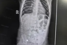 半个月接诊14例，取出硬币、回形针、电池等……儿童消化道异物怎么防？图片