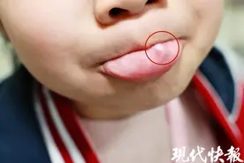 6岁女娃爱咬嘴唇！嘴里长出怪东西图片