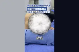罕见“肿瘤”导致女子头皮满是褶皱，医生用“水球”成功修复图片