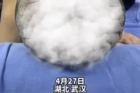 罕见“肿瘤”导致女子头皮满是褶皱，医生用“水球”成功修复图片