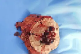 臀部上的肿块反复长？竟是恶性肿瘤！专家们联手“拆弹”清瘤图片