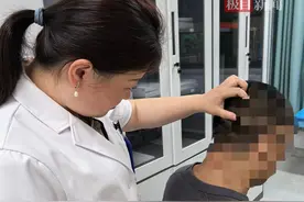 常年戴安全帽致男子环状脱发，医生显微镜下“插秧”8小时植发图片