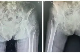 日照市中医医院：成功救治高龄髋部骨折患者图片