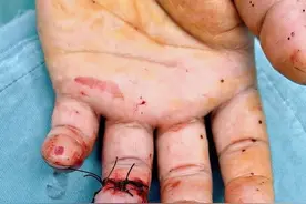 医生争分夺秒，男子车祸离断手指成功接活图片