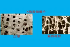 姑娘咳嗽竟咳断肋骨：过度防晒导致维生素D缺乏，骨质疏松图片