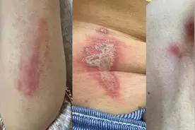 小心“飞行的硫酸” ！医院半天接诊十余例，这种小飞虫不要用手拍打图片