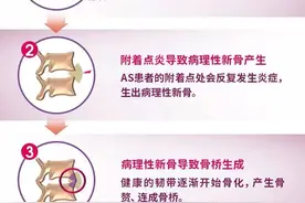 这种病好发于年轻人，18-35岁总出现腰酸背痛一定要重视！图片