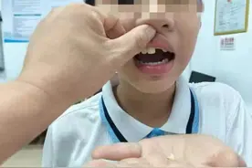 嬉闹间门牙磕断，精湛技术巧妙再接！厦门市苏颂医院口腔科专业技术及优质服务获赞图片