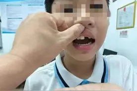 嬉闹间门牙磕断，精湛技术巧妙再接！厦门市苏颂医院口腔科专业技术及优质服务获赞图片
