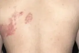女子拆快递后被确诊，疼痛难忍！超九成人体内潜伏！图片