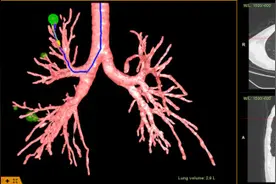 5个肺结节一次锁定精准切除！“增强现实导航技术”尤其适合多原发肺癌患者图片