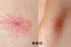 34岁男子确诊肝癌！身上长出这东西，千万警惕…图片
