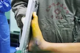 孩子“扁平足”不容轻视！龙口市中医医院微创手术解决患者足下之难图片
