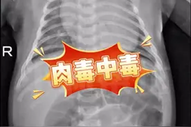 52天婴儿喝奶奶喂的蜂蜜水后中毒进ICU，医生提醒：1岁以下婴儿不宜食用蜂蜜图片