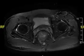 5次转移、4次手术，结直肠癌OS超8年，如何实现？图片