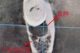 女子镶牙时竟意外发现嘴里有颗“隐形炸弹”！该病极为隐匿，做好这事是关键图片