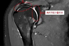 女子麻将桌上“鏖战”三天，下牌桌险些“生活不能自理”，医生提醒：娱乐需适度，多活动勿久坐图片