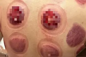 看着都痛！男子拔火罐“拔出”满背水疱图片
