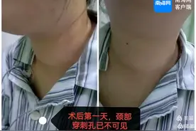 儋州市人民医院开展首例甲状旁腺腺瘤射频消融手术图片