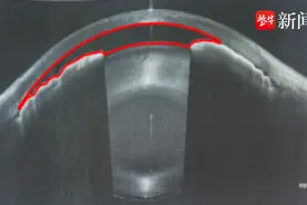 前房“一线天”！巧用飞秒激光辅助治疗高危“白内障”丨医学前沿图片
