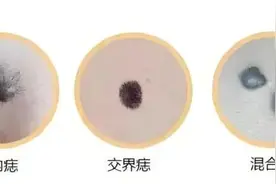 危险的痣长啥样？记住这个“ABCDE法则”！图片
