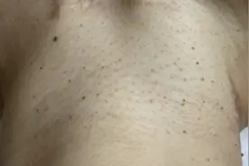 注意！脖子上的“小肉球”可能是HPV感染图片