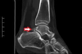 脚后跟疼痛？株洲市中医伤科医院胫踝科提醒要警惕这个“病”图片