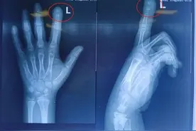 7岁男孩因咬手指致感染，手指差点没了！网友：我从小啃到大……医生提醒：要改图片