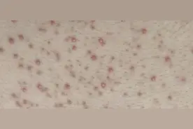 近期高发！这种小红疙瘩奇痒难耐，很多人却错把它当痘痘治，白白遭罪图片