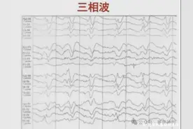 【垂医科普】神经内科： 快速进展性痴呆之 | 克-雅病图片