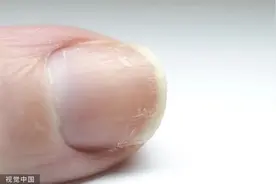 指甲有竖纹、凹陷是疾病前兆？出现这些异常才是身体在报警！图片