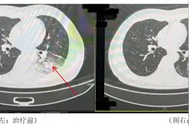 成都一男子吹空调致“白肺”，专家提醒警惕军团菌肺炎图片