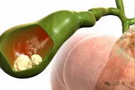 胆囊切除对身体有影响吗图片