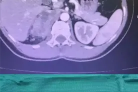 健康小站丨发病率仅1/100万！如何应对肾上腺皮质癌？他们这么做图片