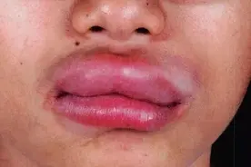 别笑！突发“香肠嘴”也可能危及生命图片