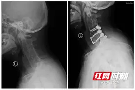中南大学湘雅医院骨科常德病区为强直性脊柱炎患者成功开展高难度颈椎骨折手术图片