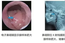 儿童“腺样体肥大”危害多多！这些症状家长要注意→图片