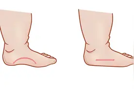 儿童扁平足需要治疗吗？松江医生为你科普｜健康智慧屋图片