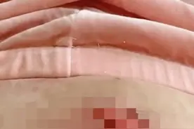一觉醒来，女子肚皮撕掉一块！又是这个“神器”惹的祸，医生：几乎年年都有图片