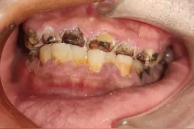 每天两瓶碳酸饮料，男子的牙被“腐蚀”！变短变薄、出现黑洞……图片