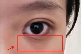 猝不及防！杭州女子年纪轻轻眼下就“黑”成这样...幸好发现的早！图片