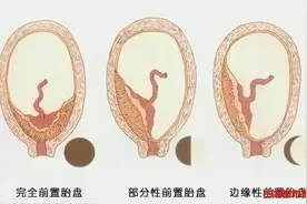 QIQI聊医疗丨“大姨妈”月月都来，25岁女子怀孕8个月不自知图片