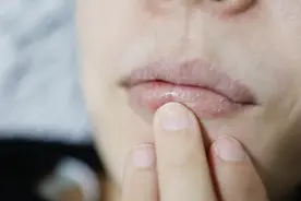 嘴唇干裂脱皮，涂唇膏也不管用？未必是缺水，而是这种炎症！图片