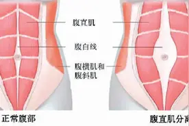 产后有了肚腩，该咋办？（医说新语）图片
