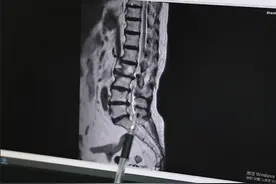 八旬老人腰痛数年步履维艰，脊柱脊髓外科两个“小孔”微创手术解椎管狭窄之困图片