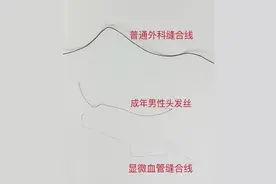 紧急救援：工人断指再植成功，中铁阜阳医院显微外科团队创造奇迹图片