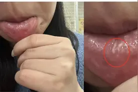 茶叶蛋在嘴里“炸开”，女子被烫伤！这种加热法很多人会做图片