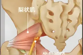 腰腿疼痛别全让腰椎“背锅”，这个病与久坐、跷二郎腿有关图片